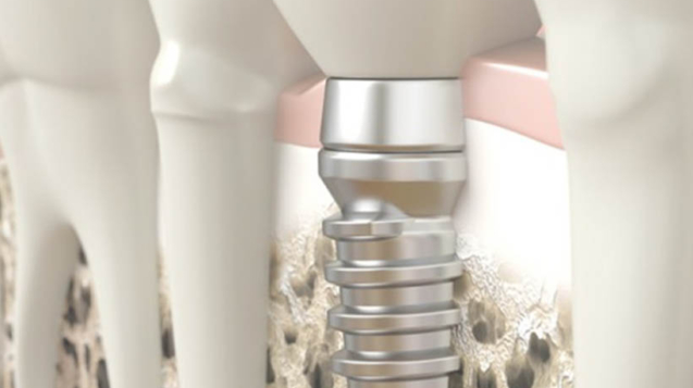 Prevenção da periimplantite